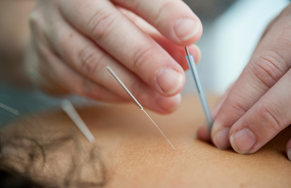 illustration 2 Acupuncture